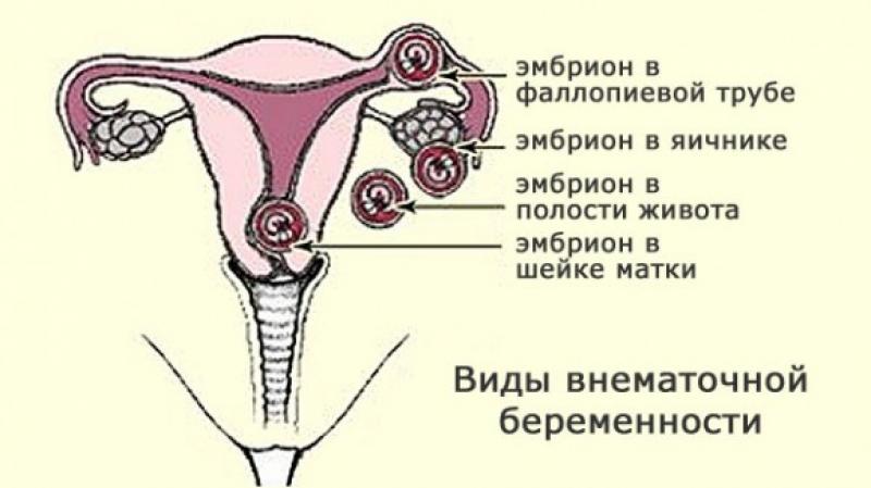 Симптомы внематочной беременности и ее последствия